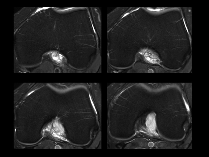 Figure 3 for case anterior cruciate ligament ( RID2781 )
